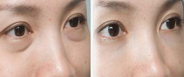 擊退眼袋，愛(ài)美女性不可錯(cuò)過(guò)