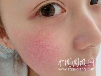 去除肌膚紅血絲小妙招